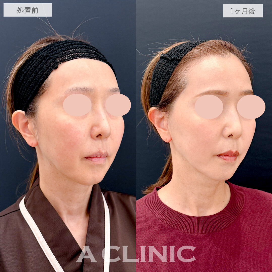 A式美肌たるみ切開でたるみのボコつきも無くなりツルンとした輪郭に！処置前と1ヶ月後の症例です(50代女性)