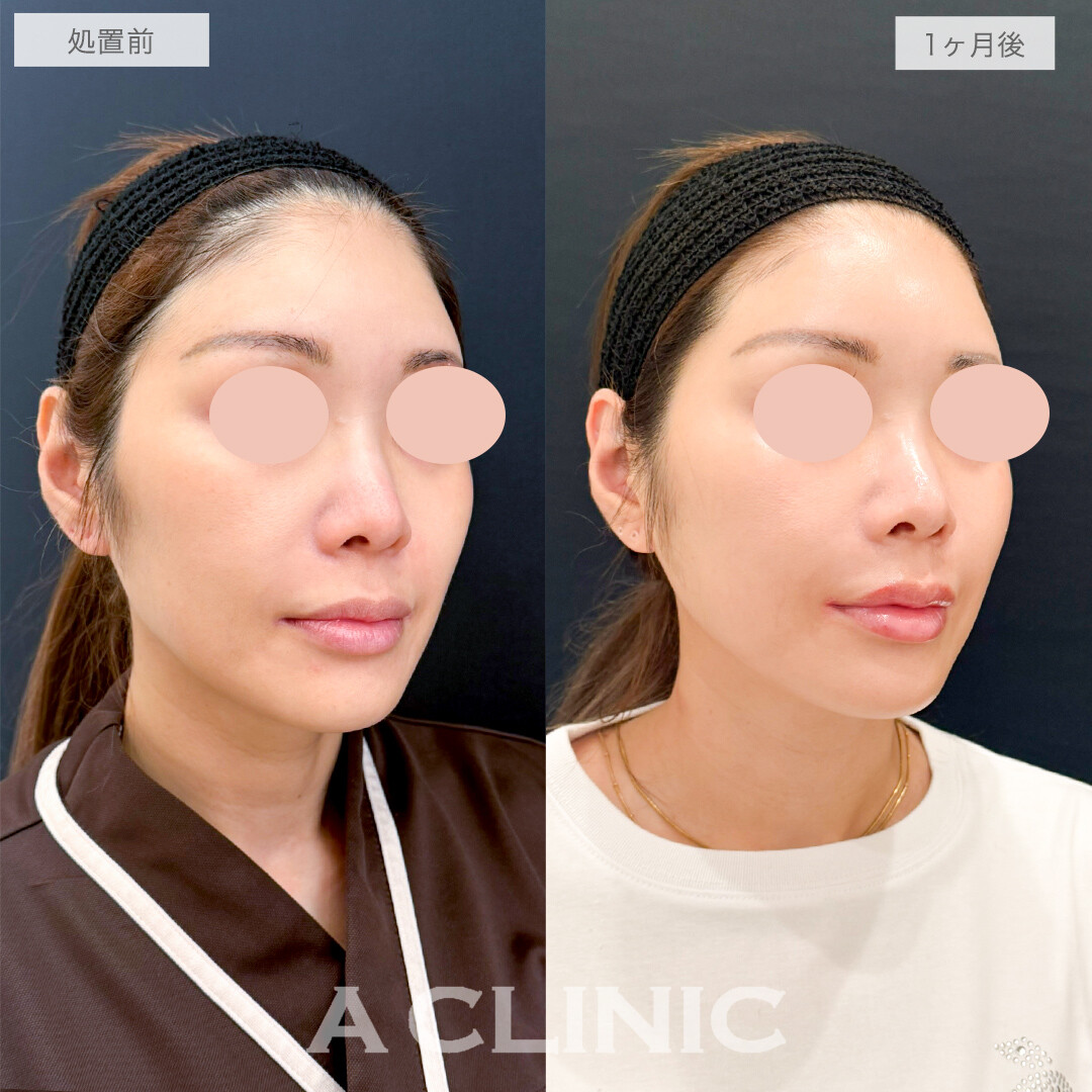 A式美肌たるみ切開でシャープなフェイスラインに！処置前と1ヶ月後の症例です(40代女性)