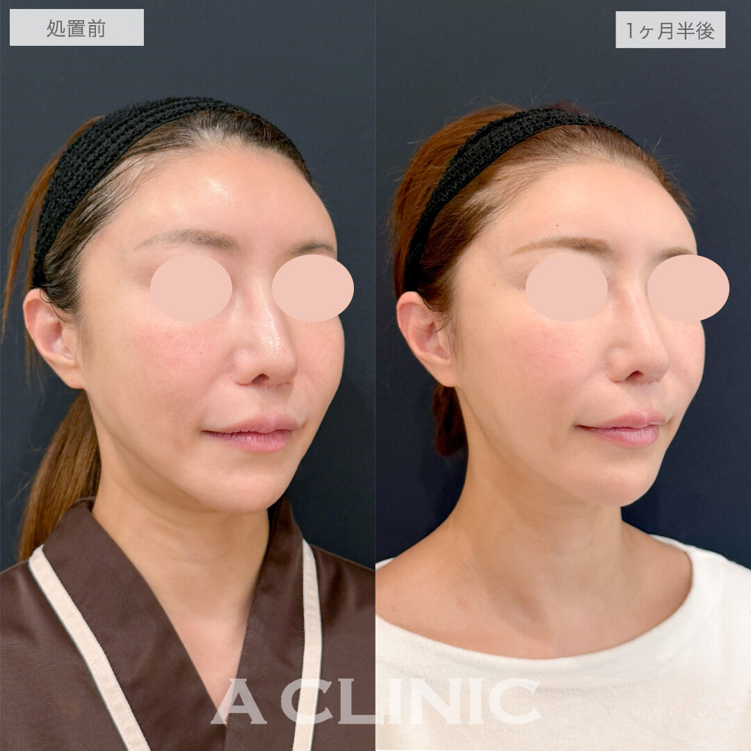 A式美肌たるみ切開で若々しいフェイスラインを取り戻す！処置前と1ヶ月半後の症例です(40代女性)