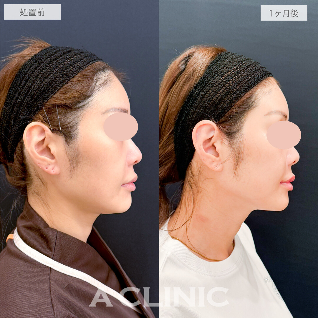 A式美肌たるみ切開でシャープなフェイスラインに！処置前と1ヶ月後の症例です(40代女性)