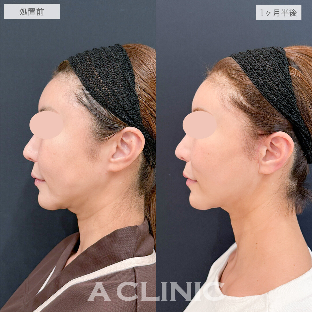 A式美肌たるみ切開で若々しいフェイスラインを取り戻す！処置前と1ヶ月半後の症例です(40代女性)