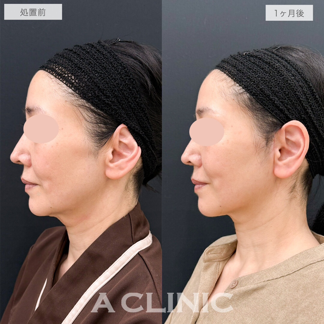 A式美肌たるみ切開で-10歳若返り！処置前と1ヶ月後の症例です(50代女性)