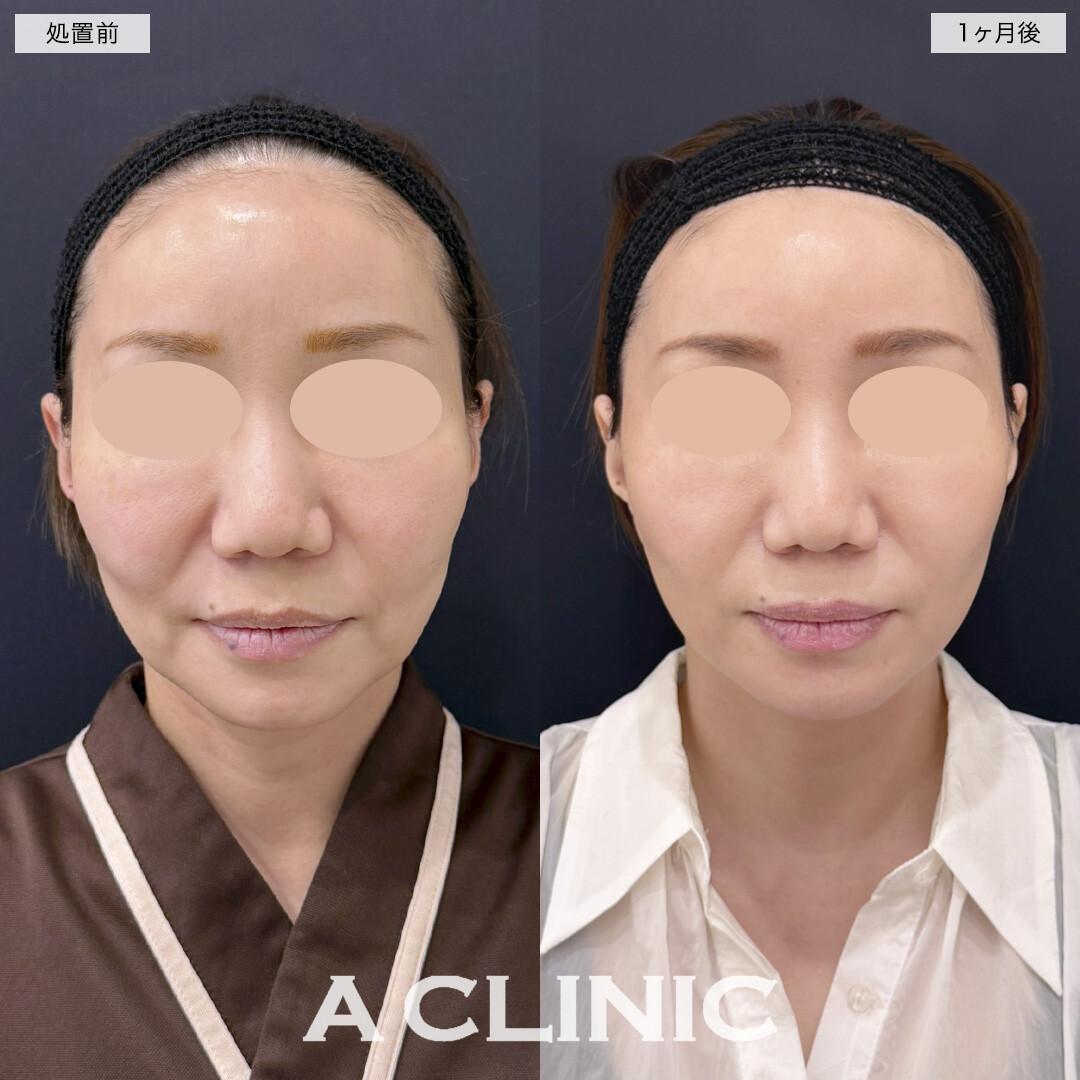 【直後の傷跡あり】A式美肌たるみ切開で下顔面のたるみ解消！処置前と1ヶ月後の症例です(40代女性)