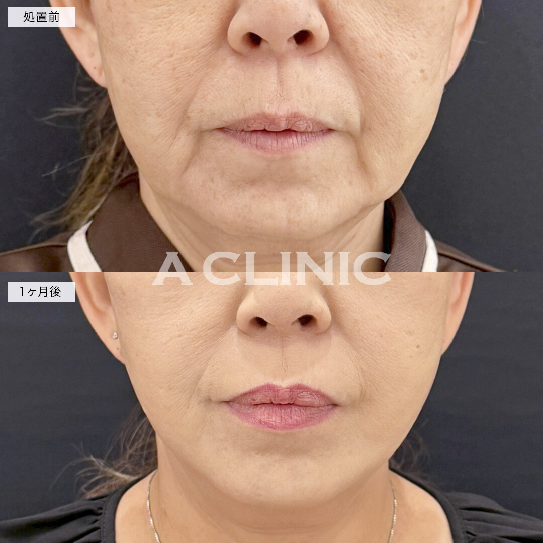 A式美肌たるみ切開で口横のたるみを改善しスッキリした輪郭に！処置前と1ヶ月後の症例です(50代女性)