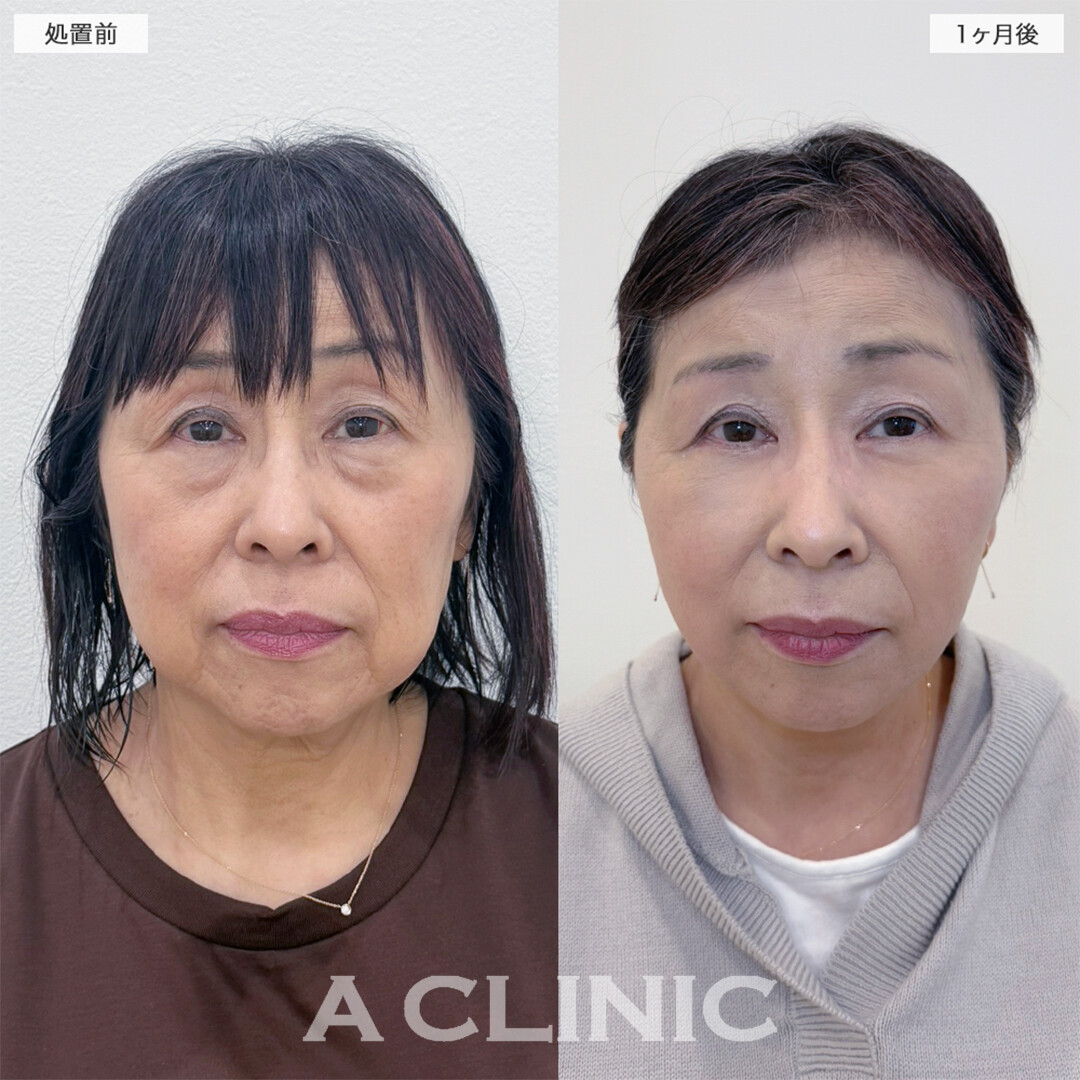 A式美肌たるみ切開と複合施術でお顔のお悩み全て解決！こちら処置前と1ヶ月後の症例です(60代女性)