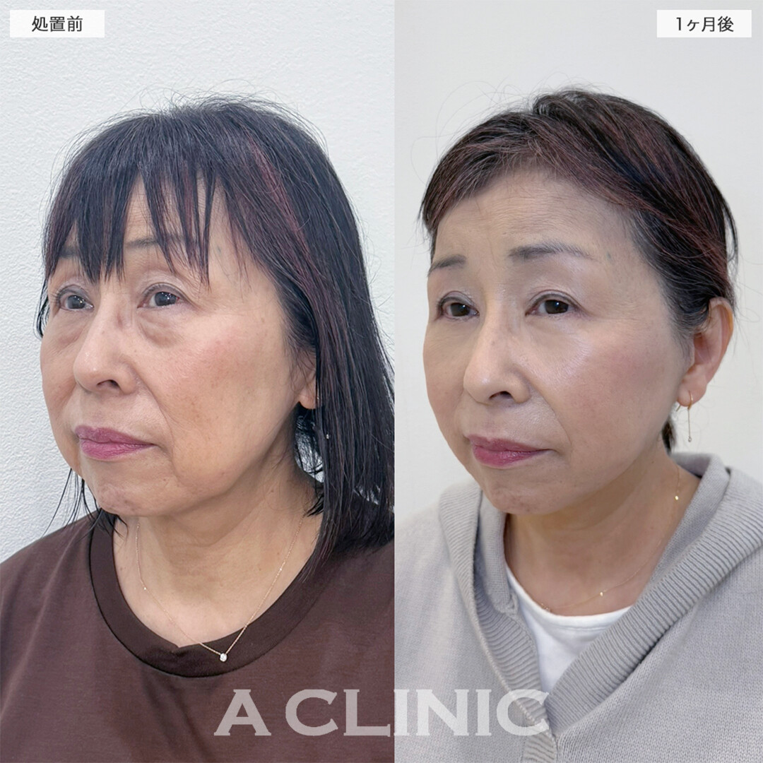 A式美肌たるみ切開と複合施術でお顔のお悩み全て解決！こちら処置前と1ヶ月後の症例です(60代女性)