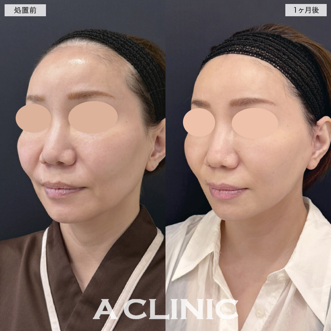 【直後の傷跡あり】A式美肌たるみ切開で下顔面のたるみ解消！処置前と1ヶ月後の症例です(40代女性)