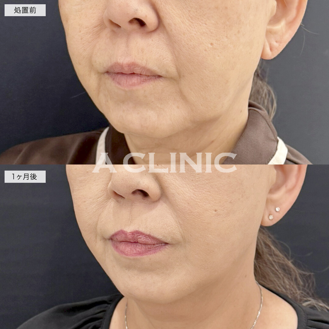 A式美肌たるみ切開で口横のたるみを改善しスッキリした輪郭に！処置前と1ヶ月後の症例です(50代女性)
