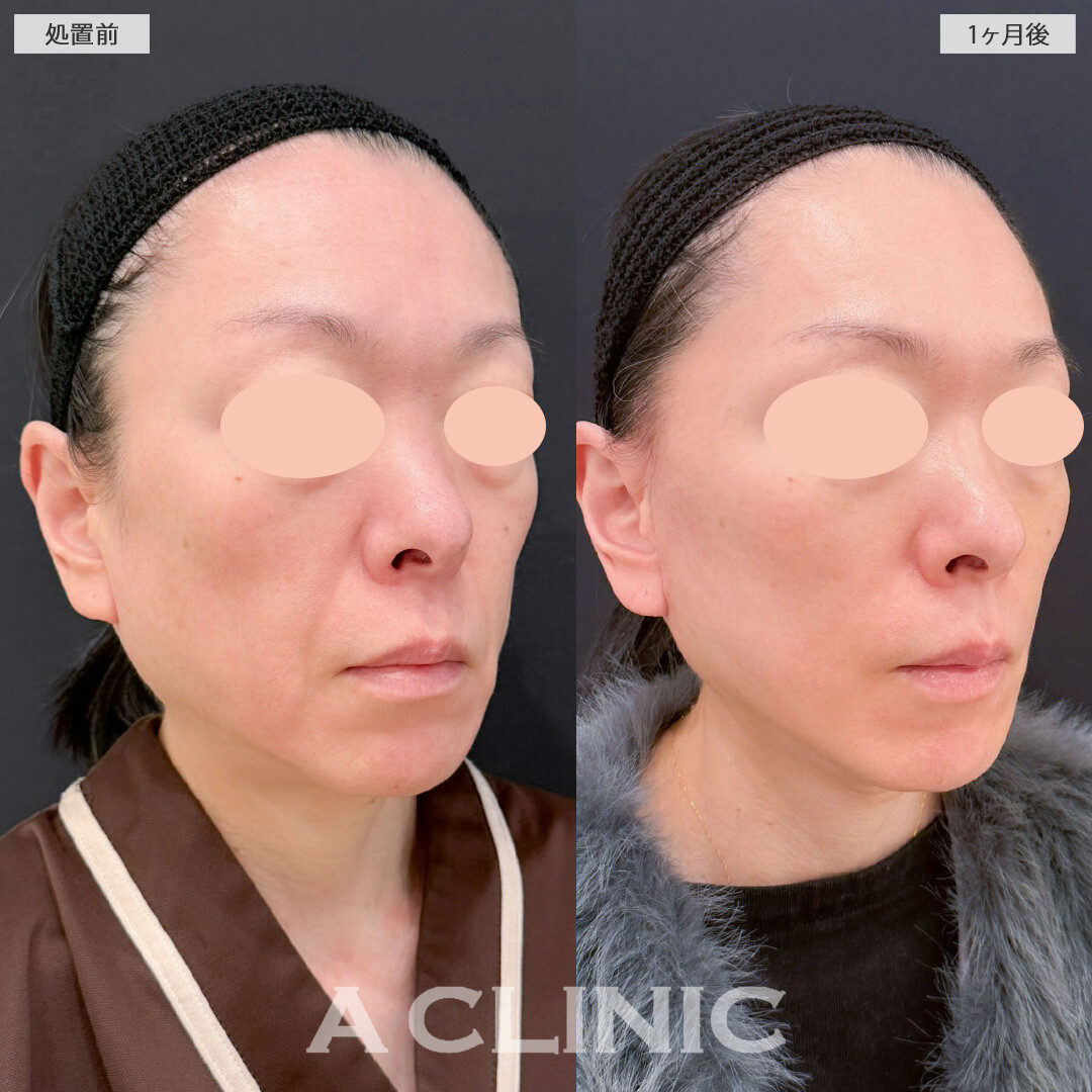 A式美肌たるみ切開と1day小顔脂肪吸引で周りにばれずに若返り成功！こちら処置前と1ヶ月後の症例です(40代女性)