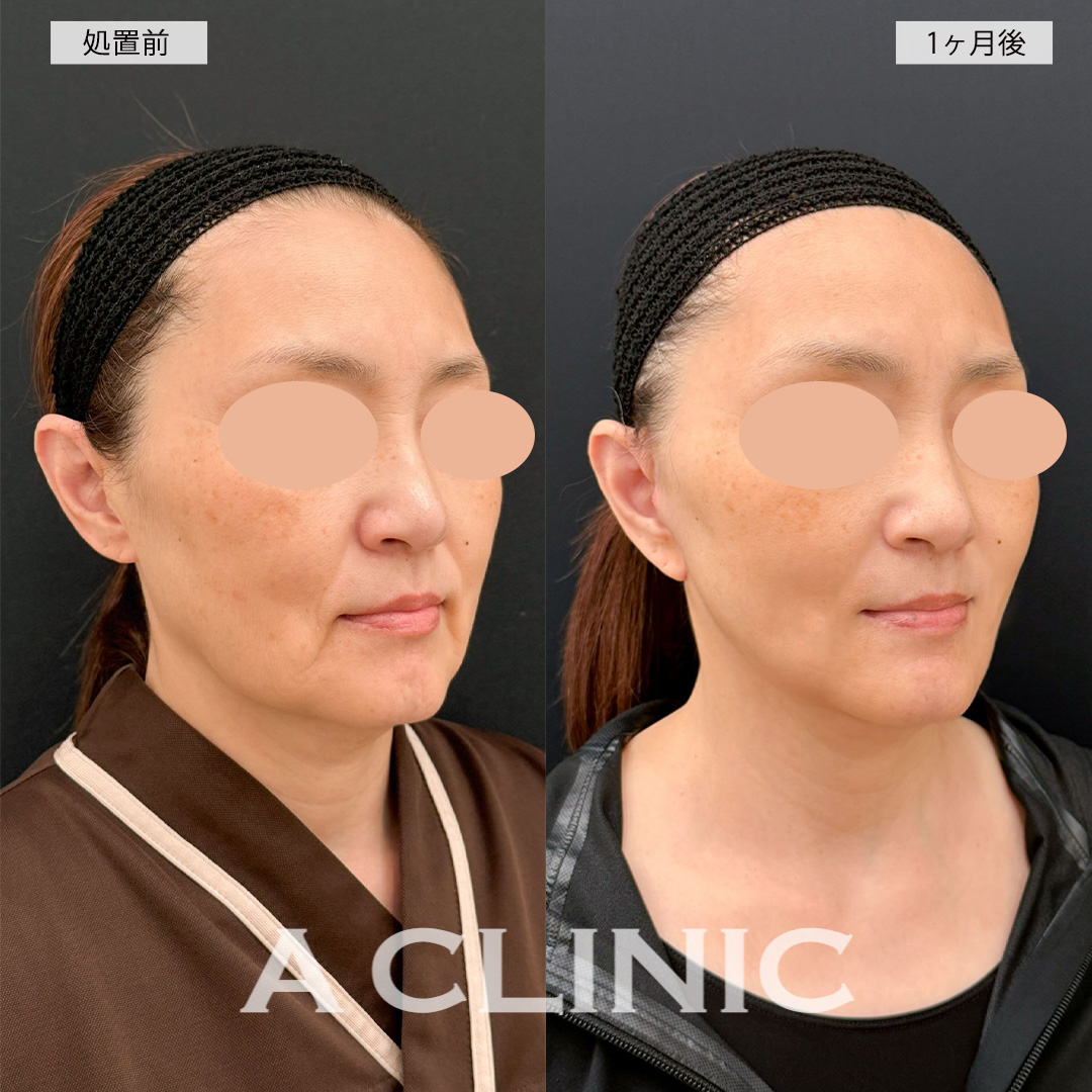 A式美肌たるみ切開で長年のお悩みのたるみが改善され産まれ変わることができました！こちら処置前と1ヶ月後の症例です(50代女性)