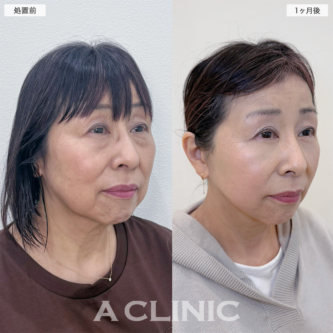 A式美肌たるみ切開と複合施術でお顔のお悩み全て解決！こちら処置前と1ヶ月後の症例です(60代女性)