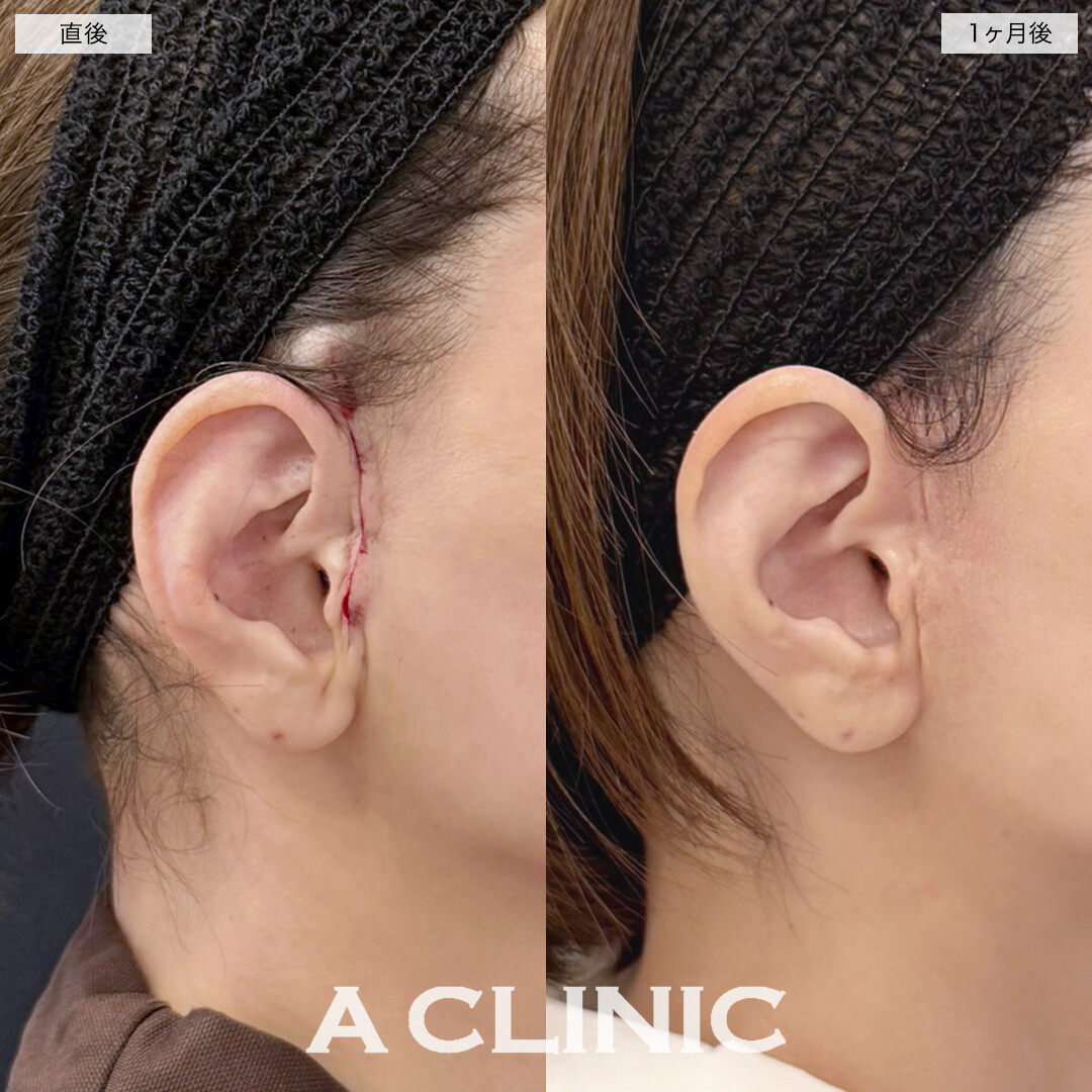 【直後の傷跡あり】A式美肌たるみ切開で下顔面のたるみ解消！処置前と1ヶ月後の症例です(40代女性)