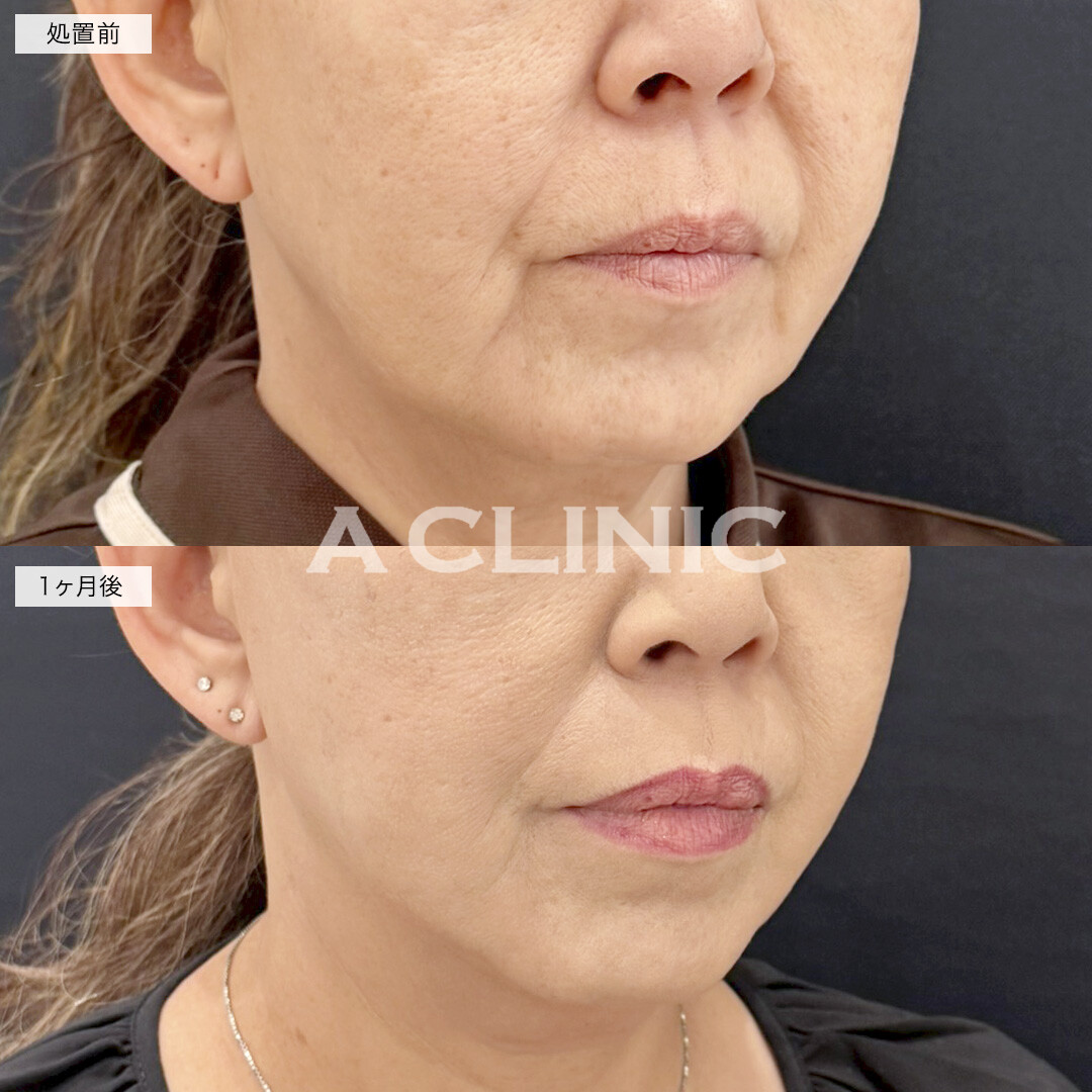 A式美肌たるみ切開で口横のたるみを改善しスッキリした輪郭に！処置前と1ヶ月後の症例です(50代女性)
