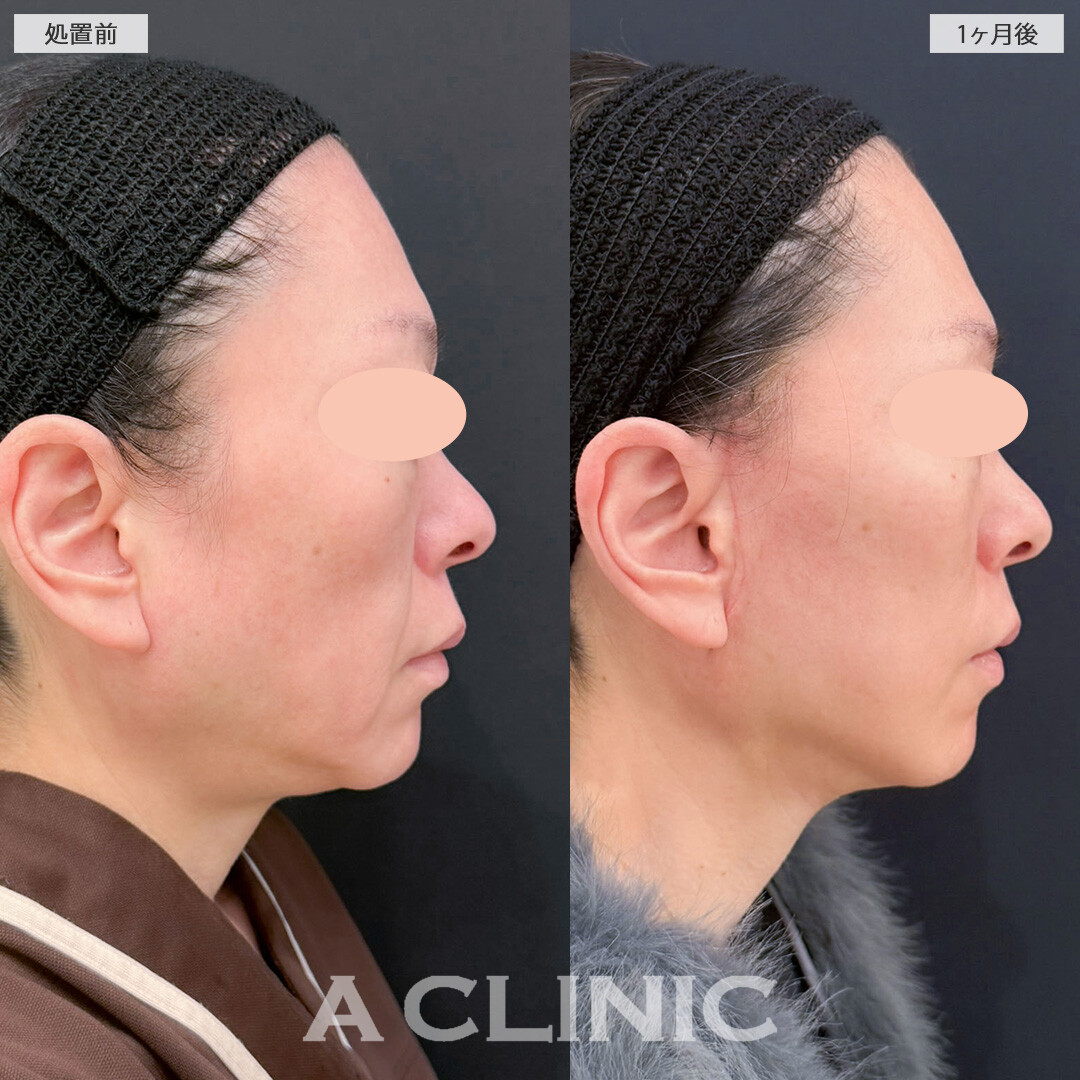 A式美肌たるみ切開と1day小顔脂肪吸引で周りにばれずに若返り成功！こちら処置前と1ヶ月後の症例です(40代女性)