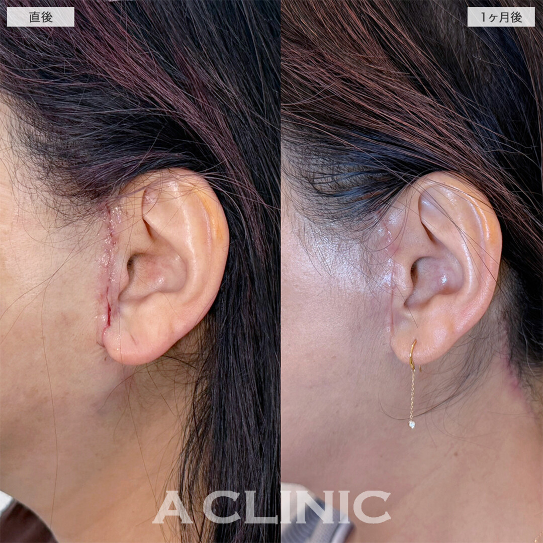 A式美肌たるみ切開と複合施術でお顔のお悩み全て解決！こちら処置前と1ヶ月後の症例です(60代女性)