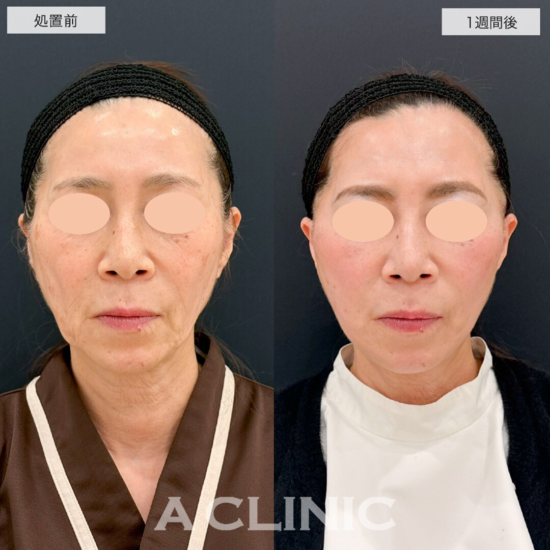 【直後の傷跡あり】A式美肌たるみ切開はダウンタイム最小限でたるみ撃退!こちら処置前と1週間後の症例です(50代女性)
