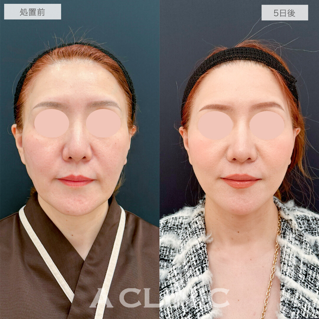A式美肌たるみ切開で若々しいハリが戻りました！処置前と5日後の症例です(50代女性)