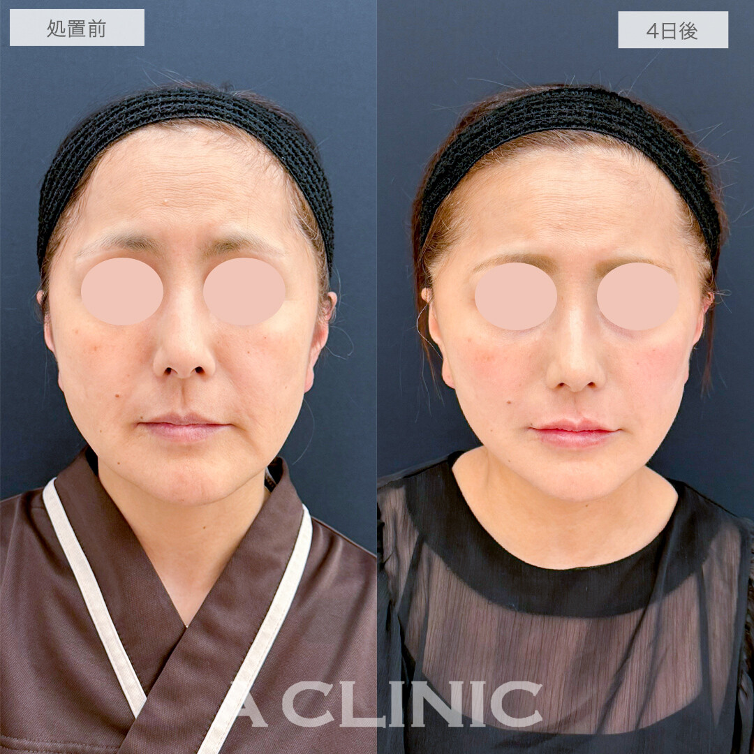 A式美肌たるみ切開でたるみのない美しい輪郭へ！処置前と4日の症例です(50代女性)