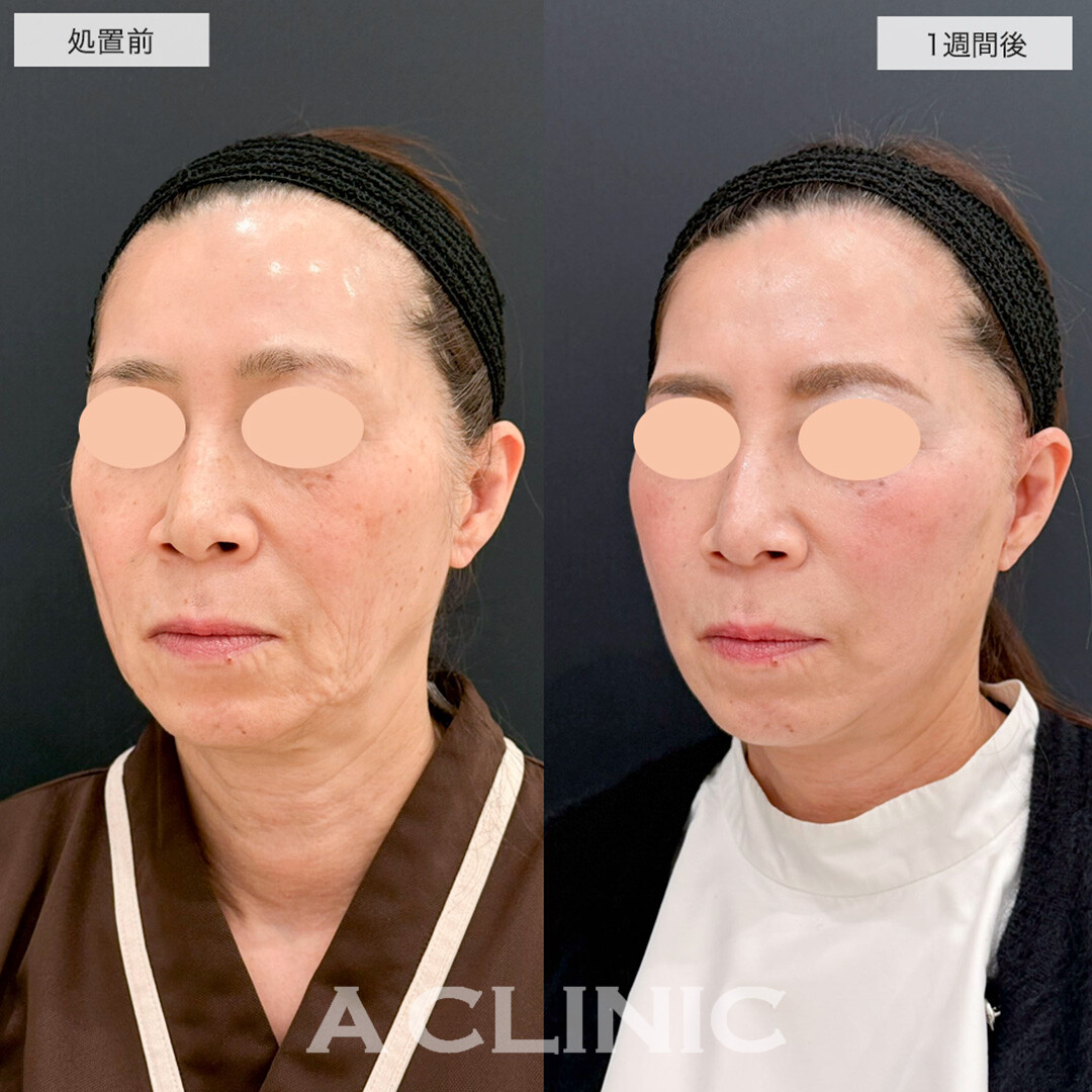 【直後の傷跡あり】A式美肌たるみ切開はダウンタイム最小限でたるみ撃退!こちら処置前と1週間後の症例です(50代女性)