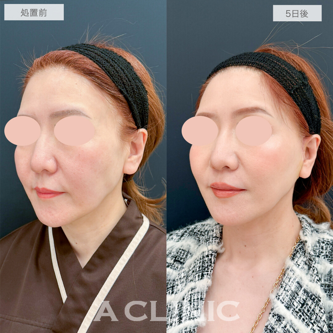 A式美肌たるみ切開で若々しいハリが戻りました！処置前と5日後の症例です(50代女性)