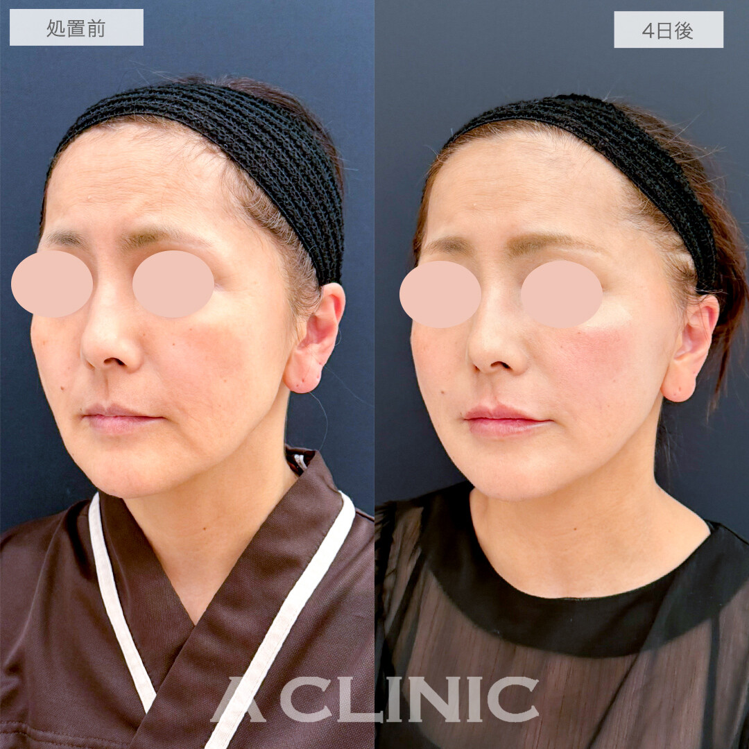 A式美肌たるみ切開でたるみのない美しい輪郭へ！処置前と4日の症例です(50代女性)