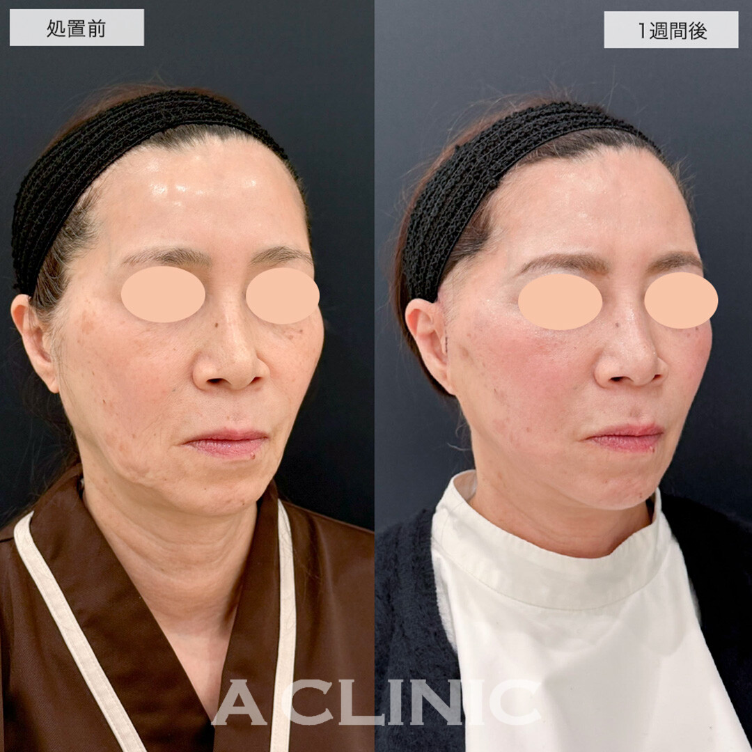 【直後の傷跡あり】A式美肌たるみ切開はダウンタイム最小限でたるみ撃退!こちら処置前と1週間後の症例です(50代女性)