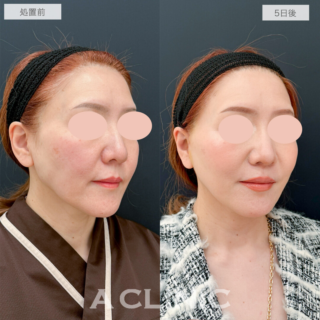 A式美肌たるみ切開で若々しいハリが戻りました！処置前と5日後の症例です(50代女性)
