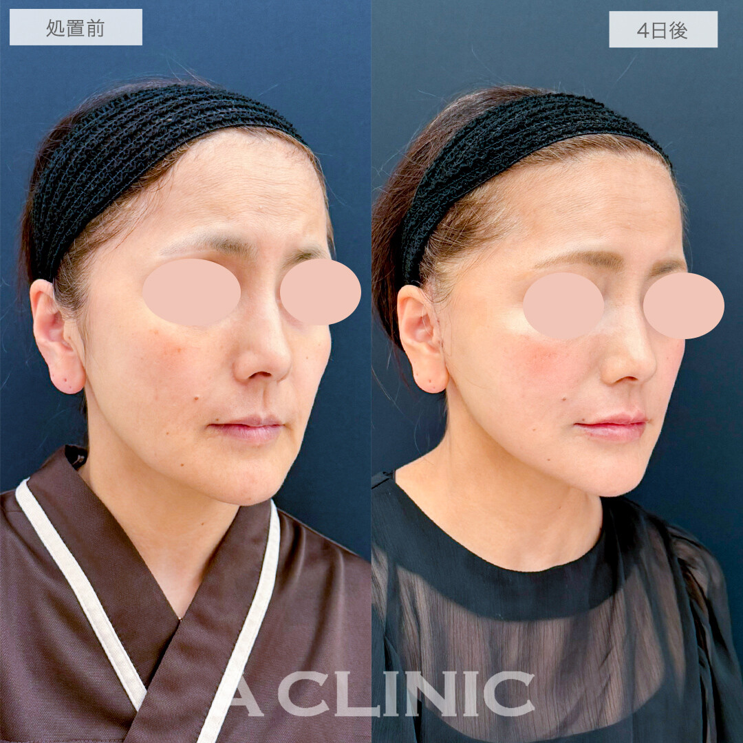 A式美肌たるみ切開でたるみのない美しい輪郭へ！処置前と4日の症例です(50代女性)