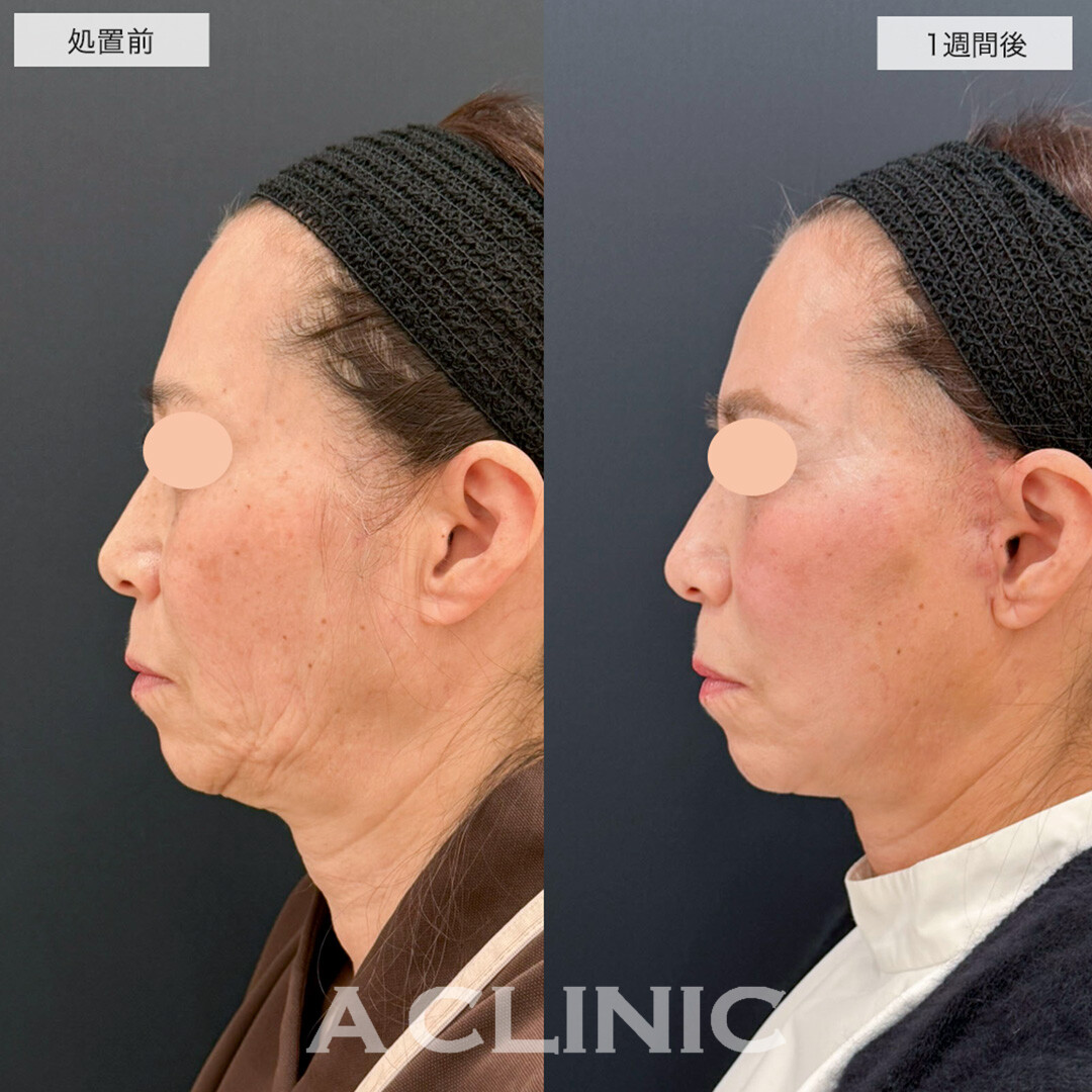 【直後の傷跡あり】A式美肌たるみ切開はダウンタイム最小限でたるみ撃退!こちら処置前と1週間後の症例です(50代女性)