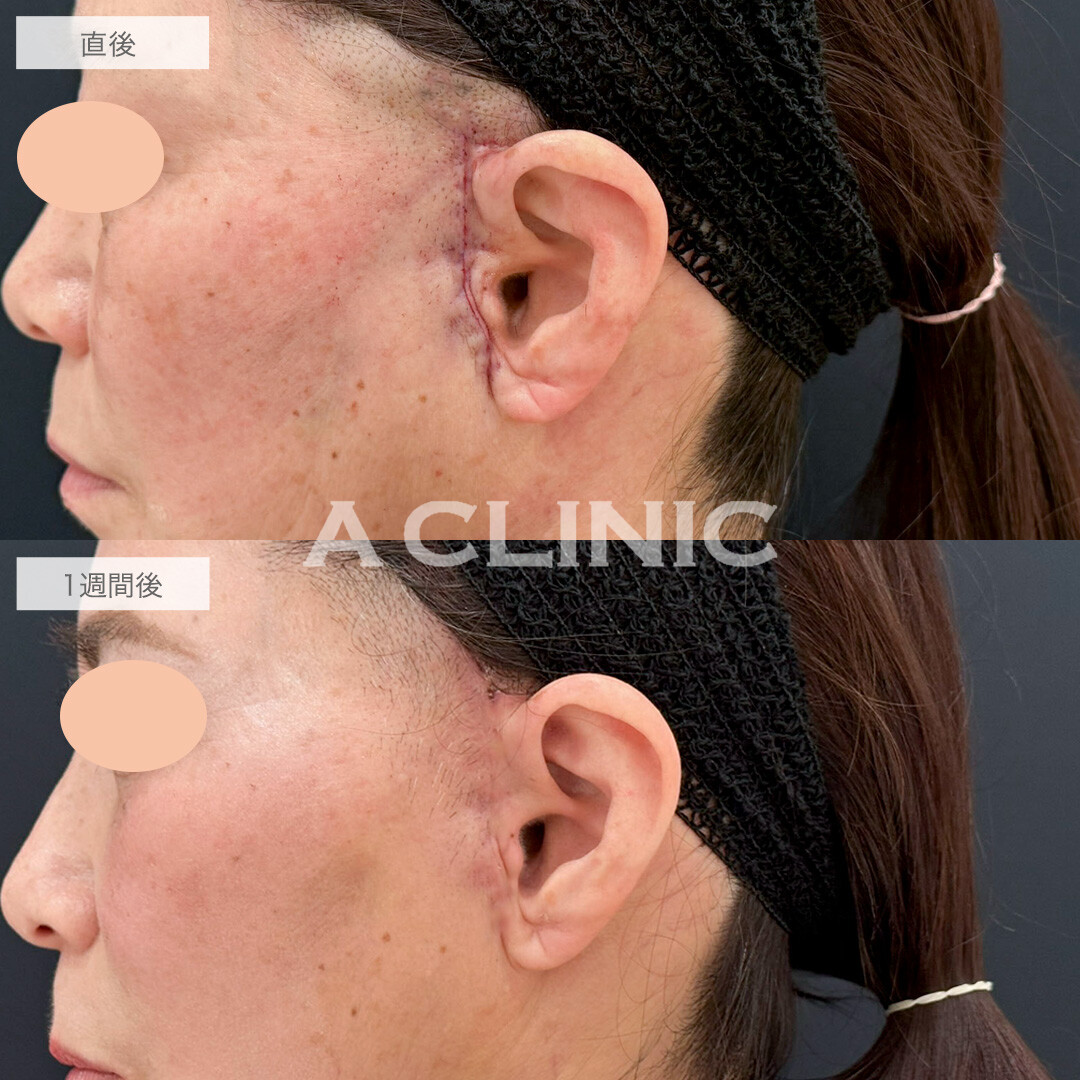 【直後の傷跡あり】A式美肌たるみ切開はダウンタイム最小限でたるみ撃退!こちら処置前と1週間後の症例です(50代女性)