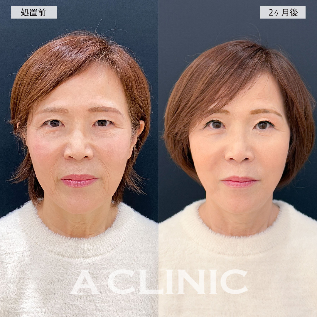 複合施術で完全若返り！こちら処置前と2ヶ月後の症例です(50代女性)