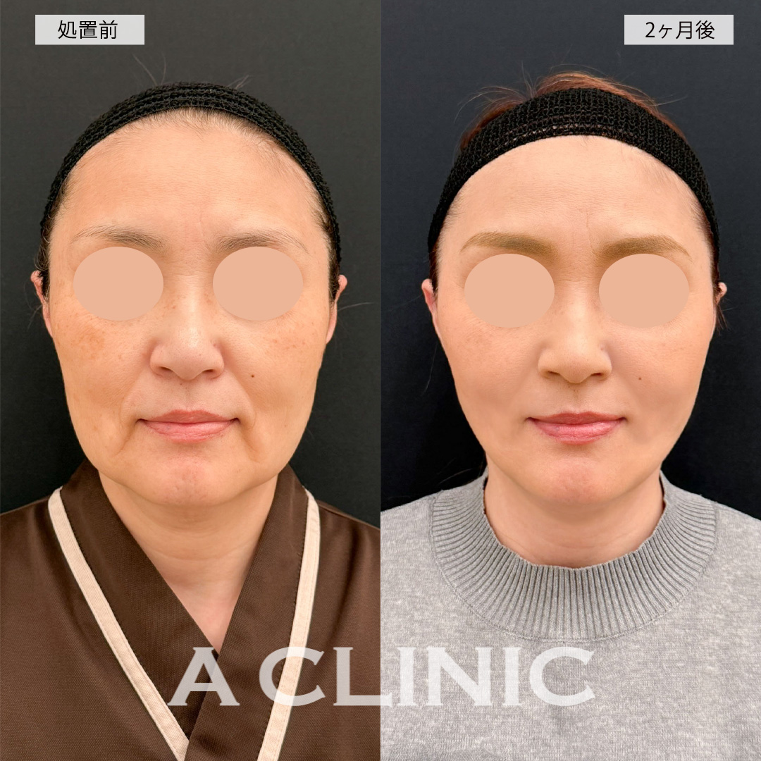 A式美肌たるみ切開と1day小顔脂肪吸引を組み合わせれば若返り効果が更にUPします！こちら処置前と2ヶ月後の症例です(50代女性)