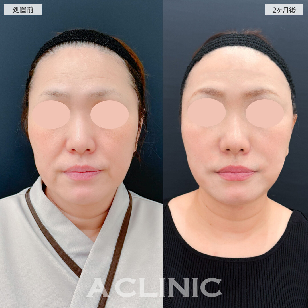 1day小顔脂肪吸引とA式美肌たるみ切開と小顔エラボトックスでたるみが気にならなくなりました！こちら処置前と2ヶ月後の症例です(50代女性)