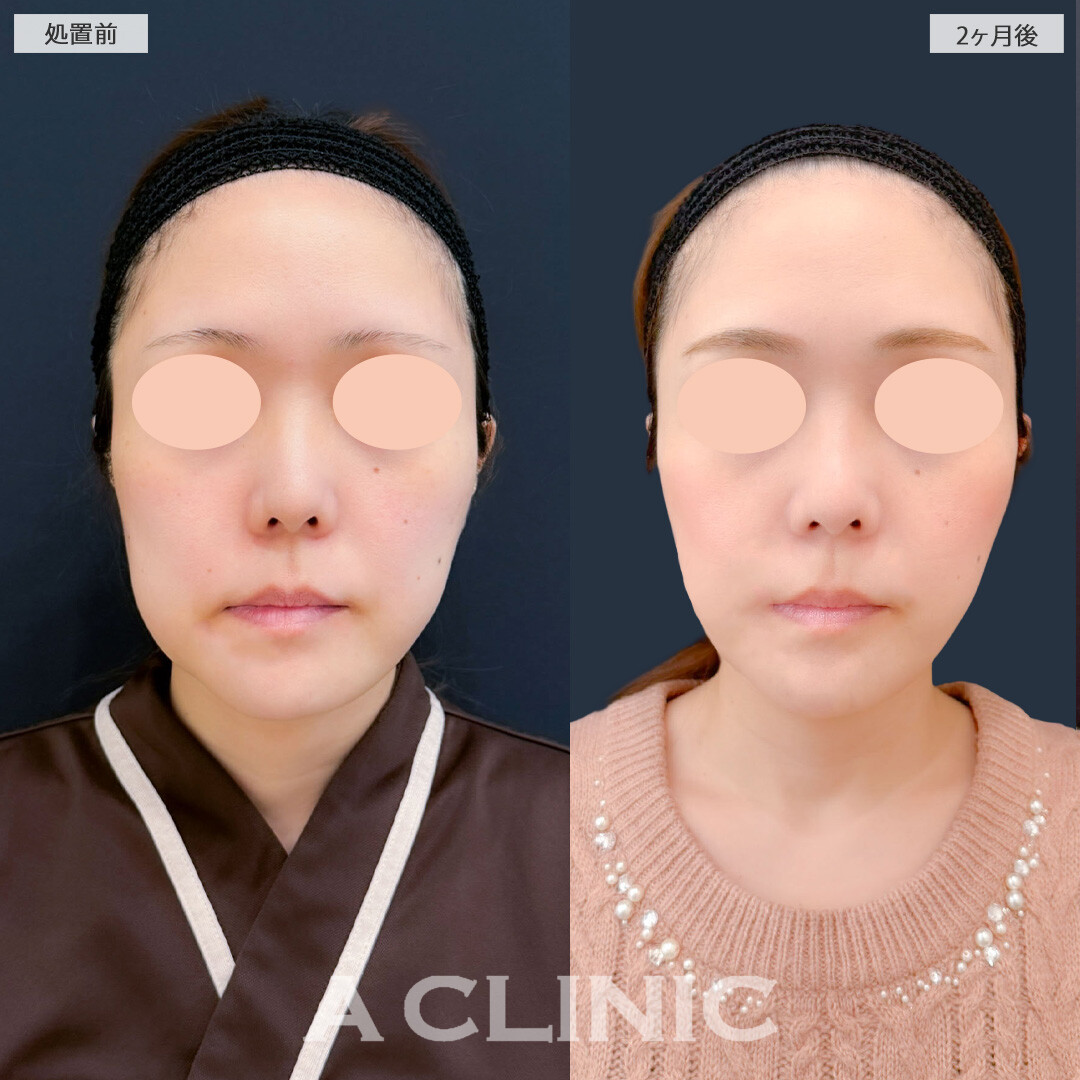 1day小顔脂肪吸引とバッカルファット除去術と小顔エラボトックスで自然に下膨れ解消！こちら処置前と2ヶ月後の症例です(30代女性)