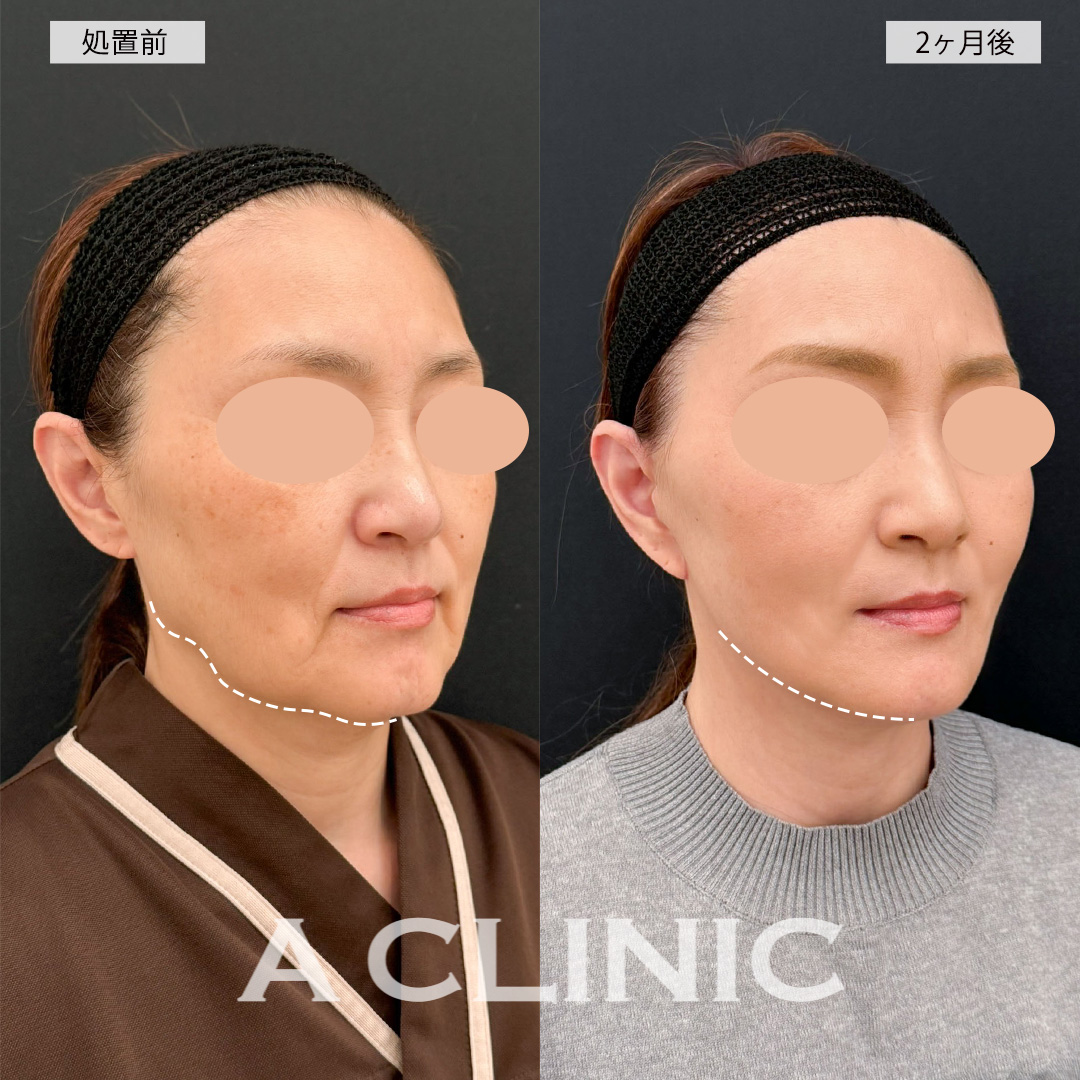 A式美肌たるみ切開と1day小顔脂肪吸引を組み合わせれば若返り効果が更にUPします！こちら処置前と2ヶ月後の症例です(50代女性)