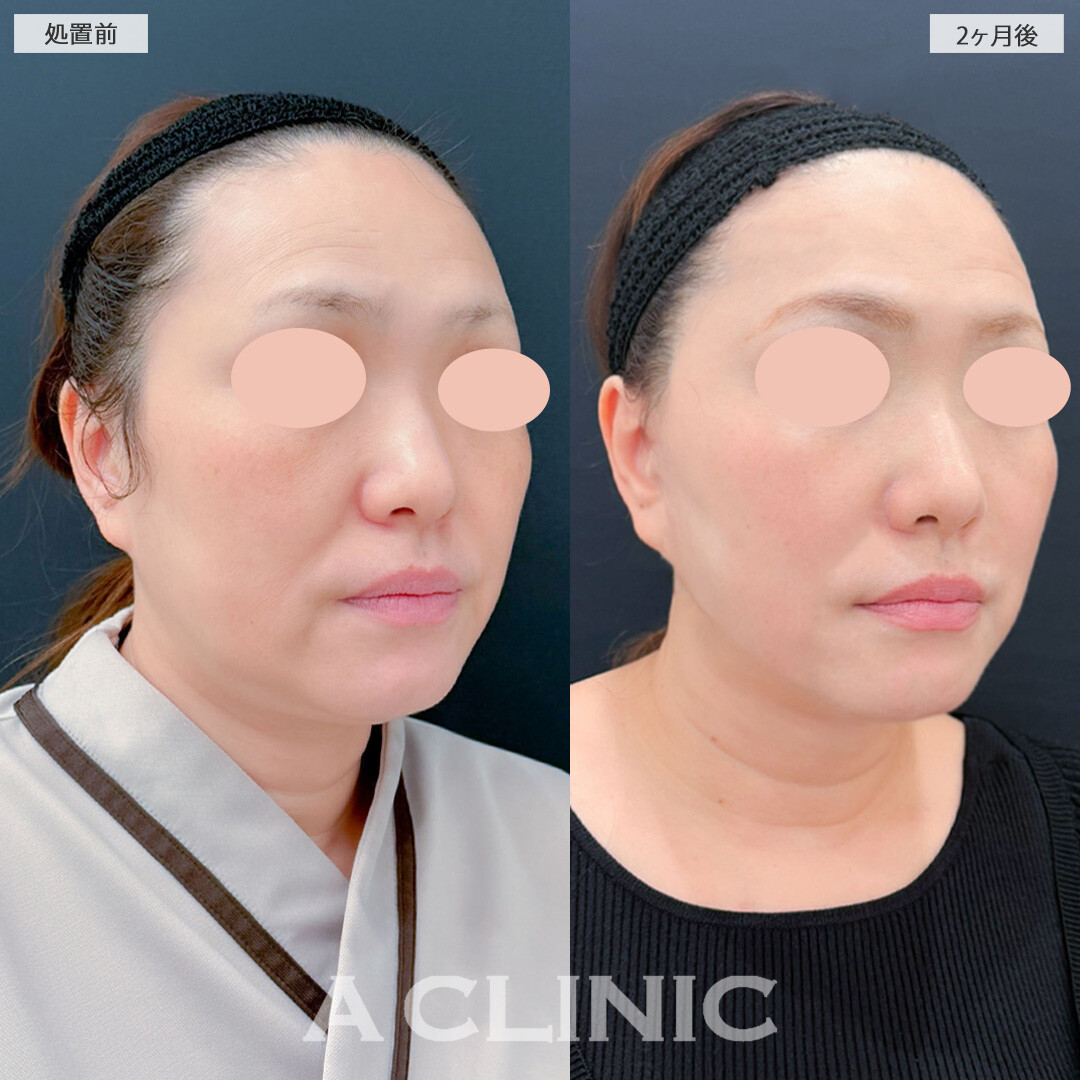 1day小顔脂肪吸引とA式美肌たるみ切開と小顔エラボトックスでたるみが気にならなくなりました！こちら処置前と2ヶ月後の症例です(50代女性)