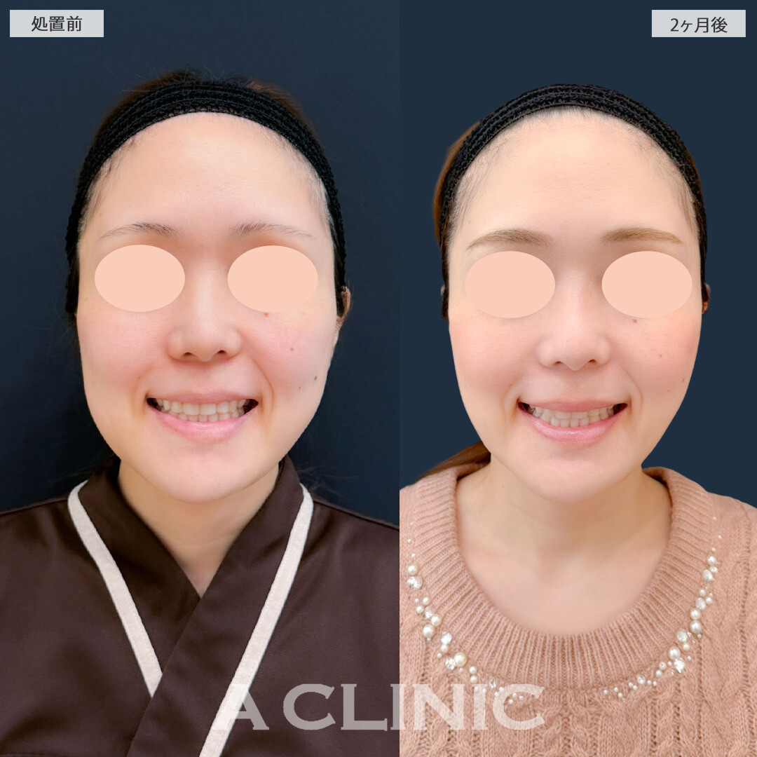 1day小顔脂肪吸引とバッカルファット除去術と小顔エラボトックスで自然に下膨れ解消！こちら処置前と2ヶ月後の症例です(30代女性)