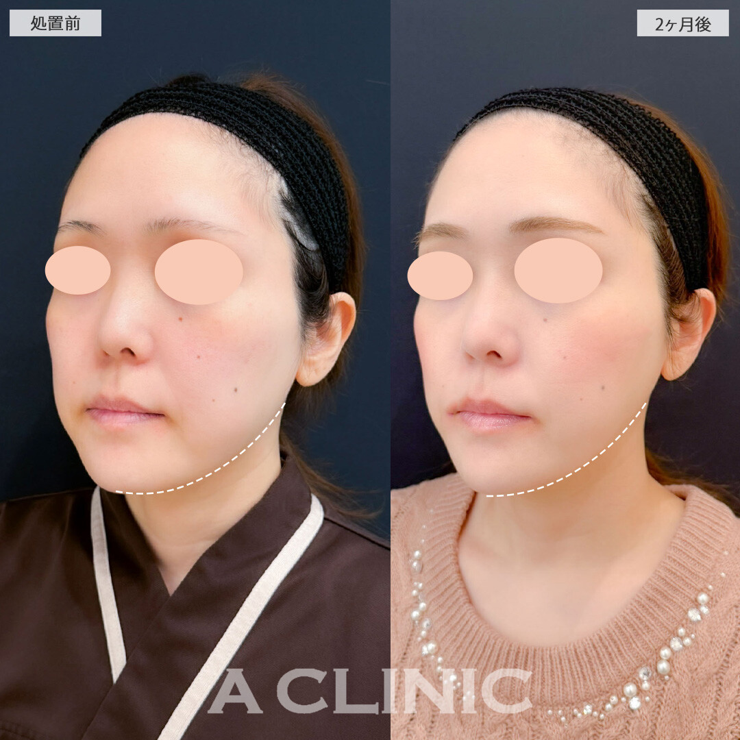 1day小顔脂肪吸引とバッカルファット除去術と小顔エラボトックスで自然に下膨れ解消！こちら処置前と2ヶ月後の症例です(30代女性)