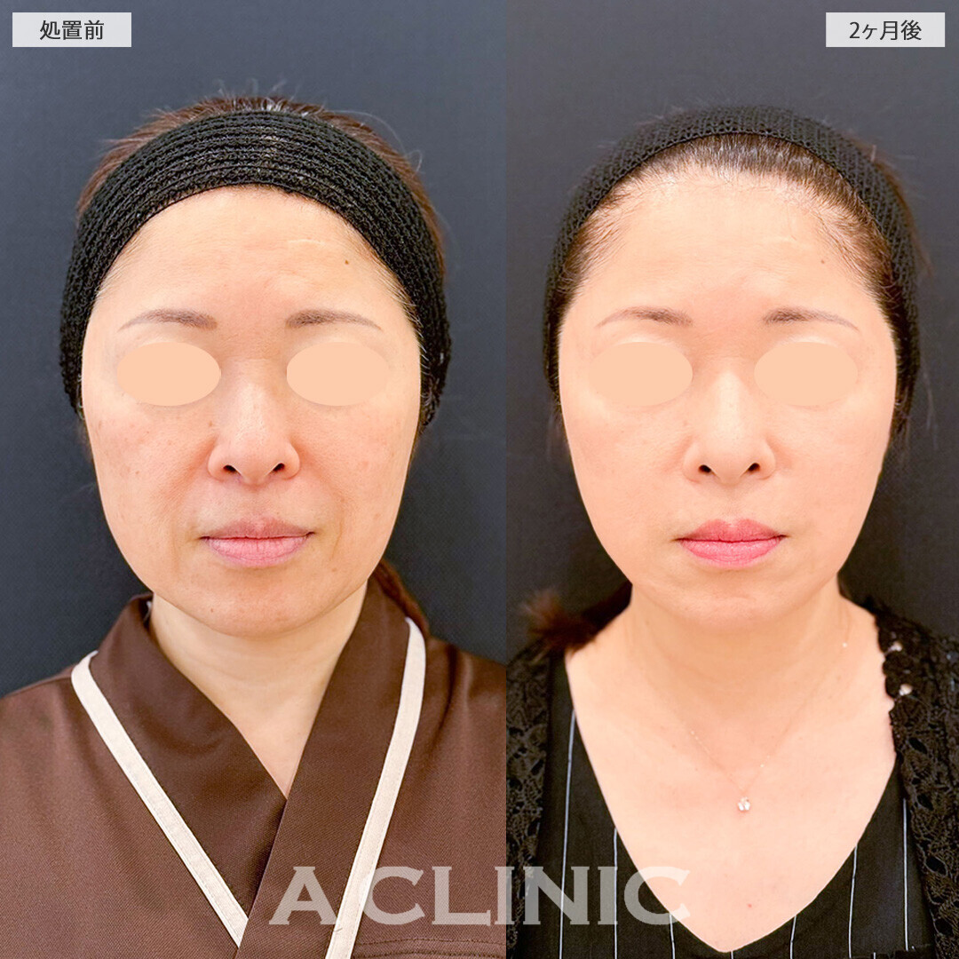 A式美肌たるみ切開ならダウンタイム最小限で若々しさを取り戻せます！こちら処置前と2ヶ月後の症例です(50代女性)