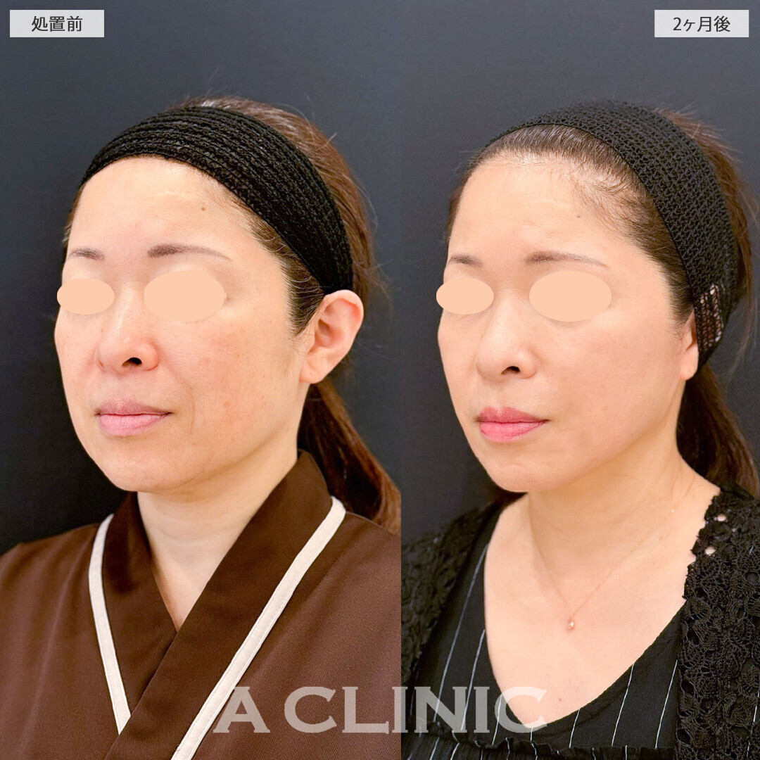 A式美肌たるみ切開ならダウンタイム最小限で若々しさを取り戻せます！こちら処置前と2ヶ月後の症例です(50代女性)