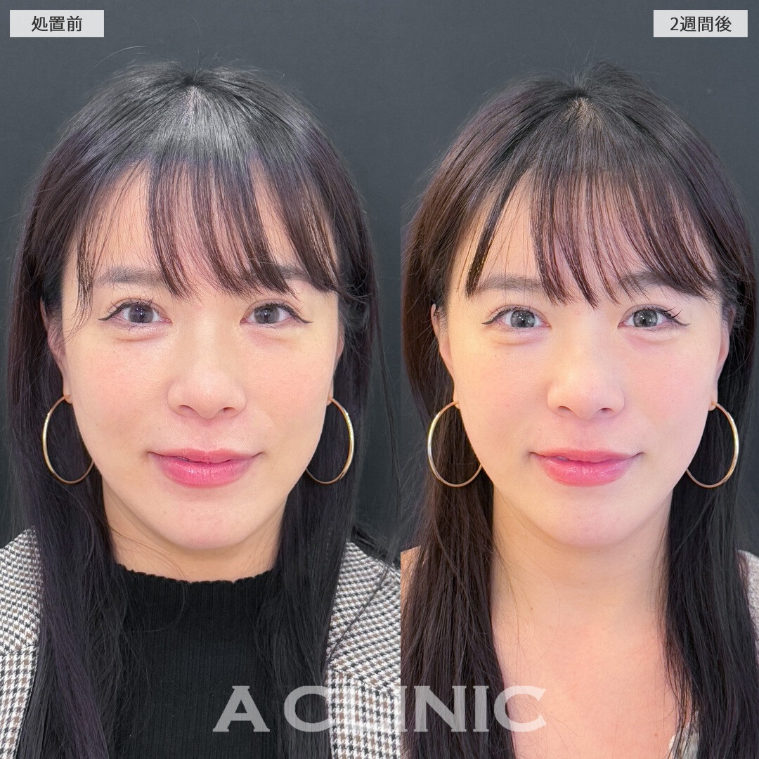 A式美肌たるみ切開でたるみを引き上げてアンチエイジング！こちら処置前と2週間後の症例です(30代女性)