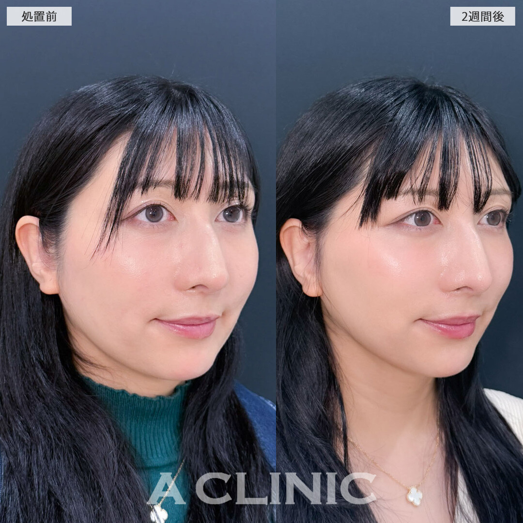 A式美肌たるみ切開でリフトアップして圧倒的若返り効果！こちら処置前と2週間後の症例です(30代女性)