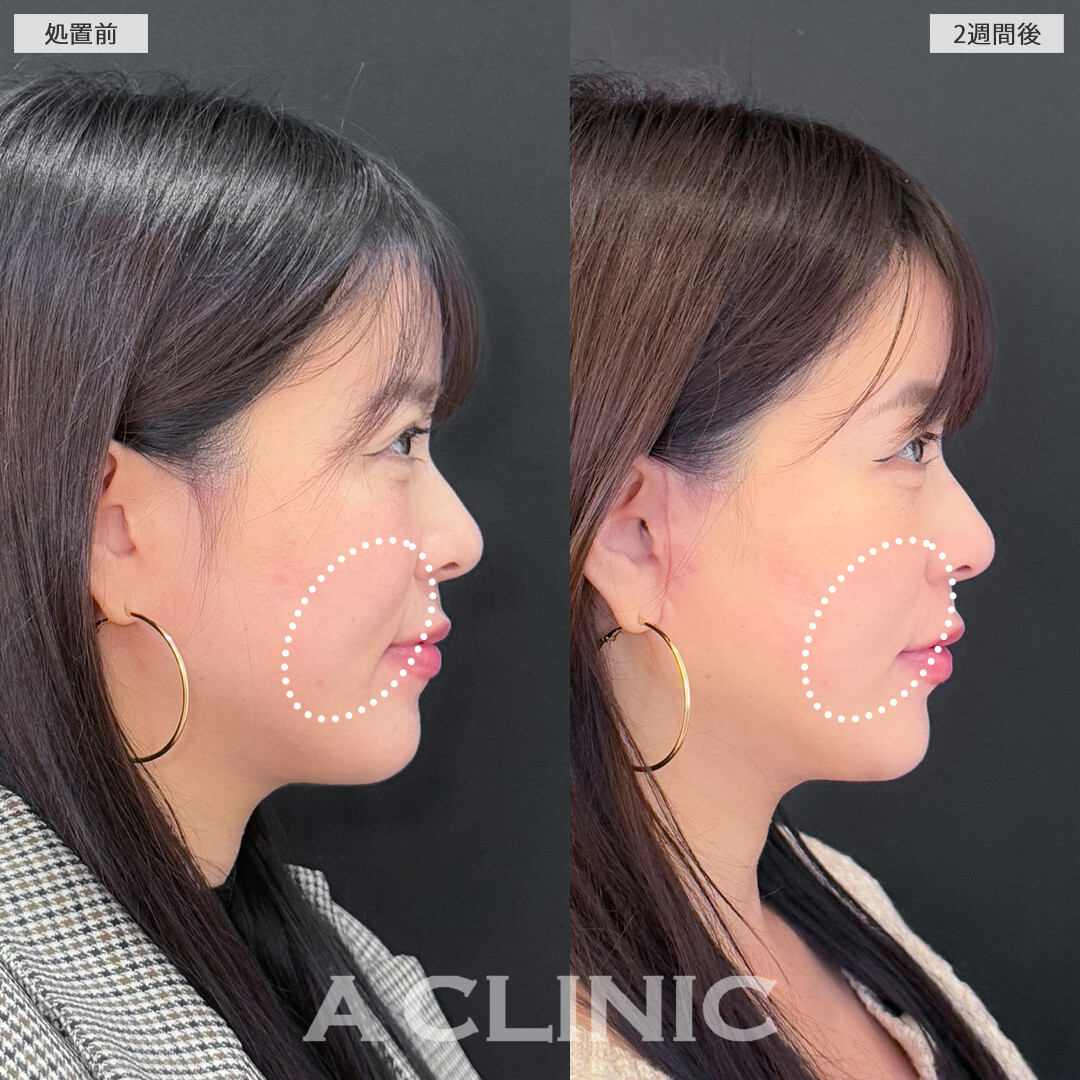 A式美肌たるみ切開でたるみを引き上げてアンチエイジング！こちら処置前と2週間後の症例です(30代女性)