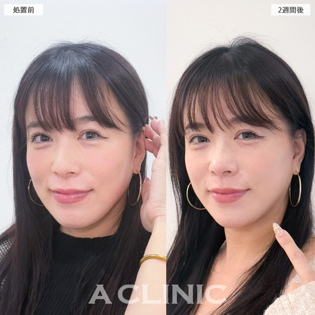 A式美肌たるみ切開でたるみを引き上げてアンチエイジング！こちら処置前と2週間後の症例です(30代女性)