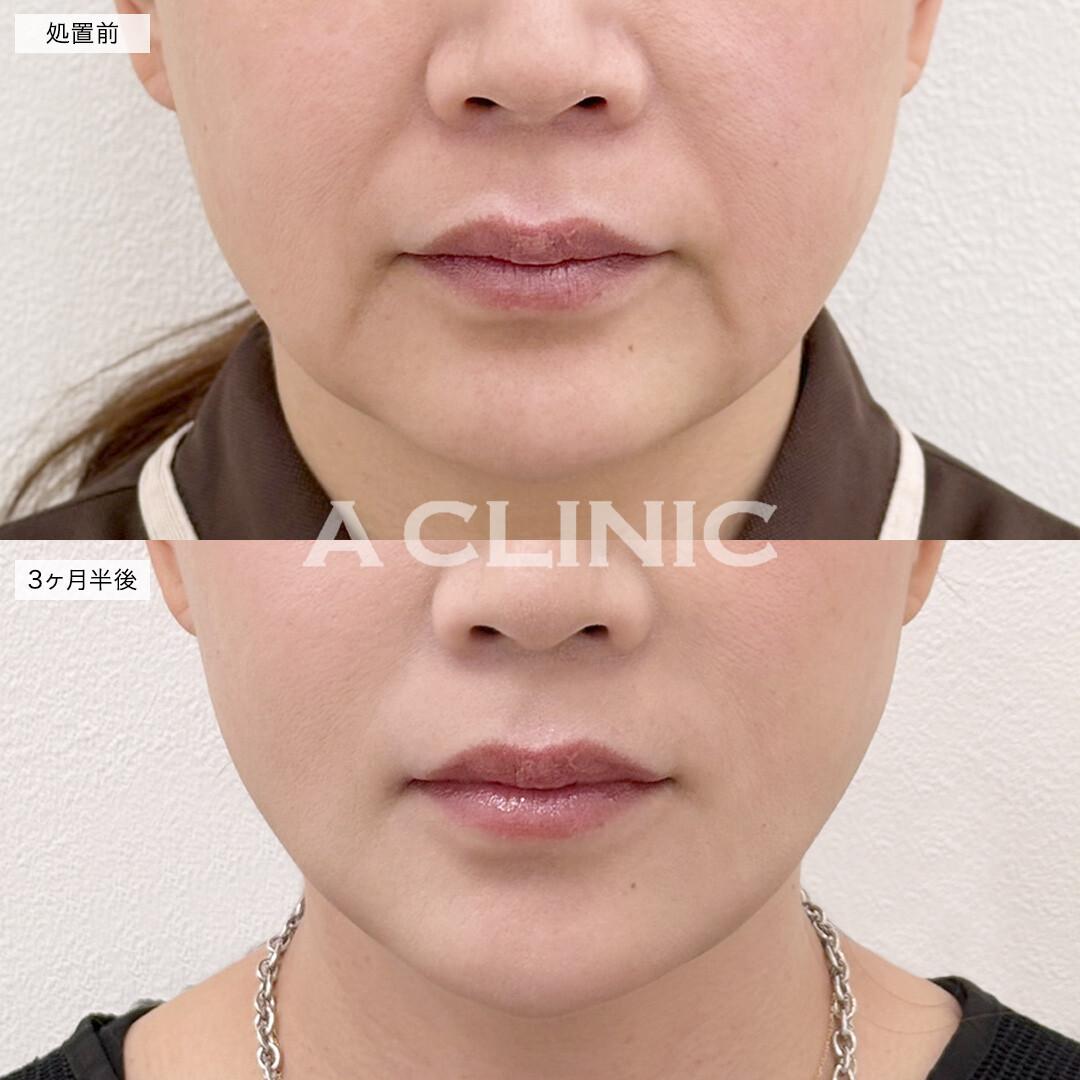 A式美肌たるみ切開と1day小顔脂肪吸引でたるみのないスッキリとしたフェイスラインに！処置前と3ヶ月半後の症例です(50代女性)