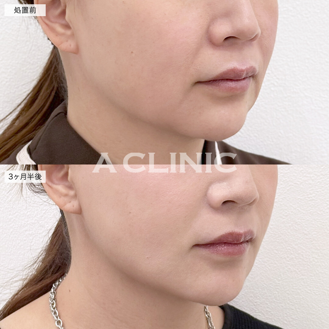 A式美肌たるみ切開と1day小顔脂肪吸引でたるみのないスッキリとしたフェイスラインに！処置前と3ヶ月半後の症例です(50代女性)