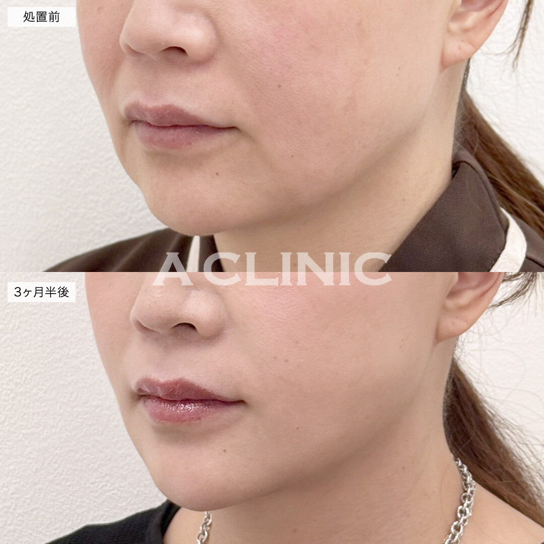 A式美肌たるみ切開と1day小顔脂肪吸引でたるみのないスッキリとしたフェイスラインに！処置前と3ヶ月半後の症例です(50代女性)