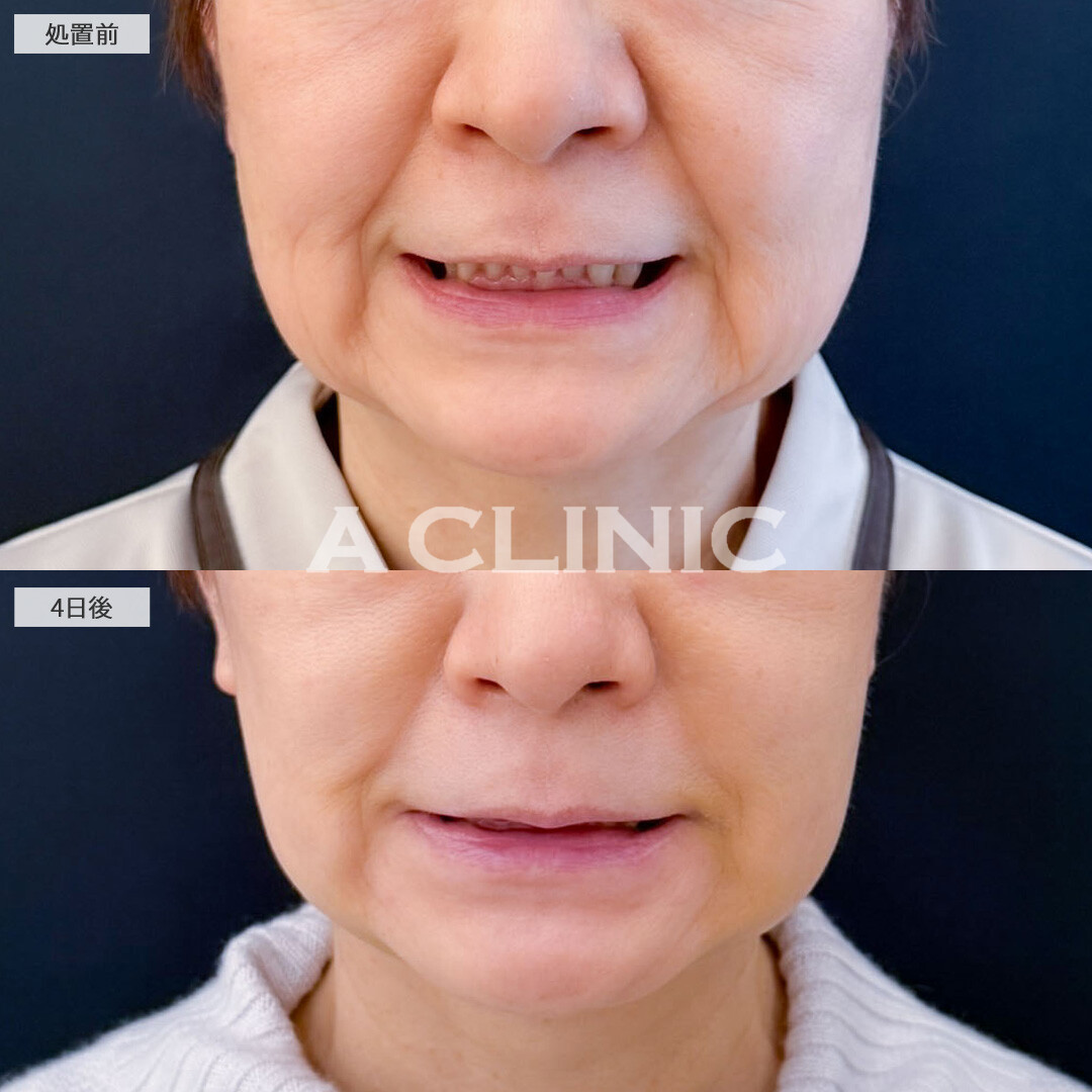 1day小顔脂肪吸引で年齢と共に落ちてきた脂肪を無くしてスッキリ！こちら処置前と4日後の症例です(60代女性)