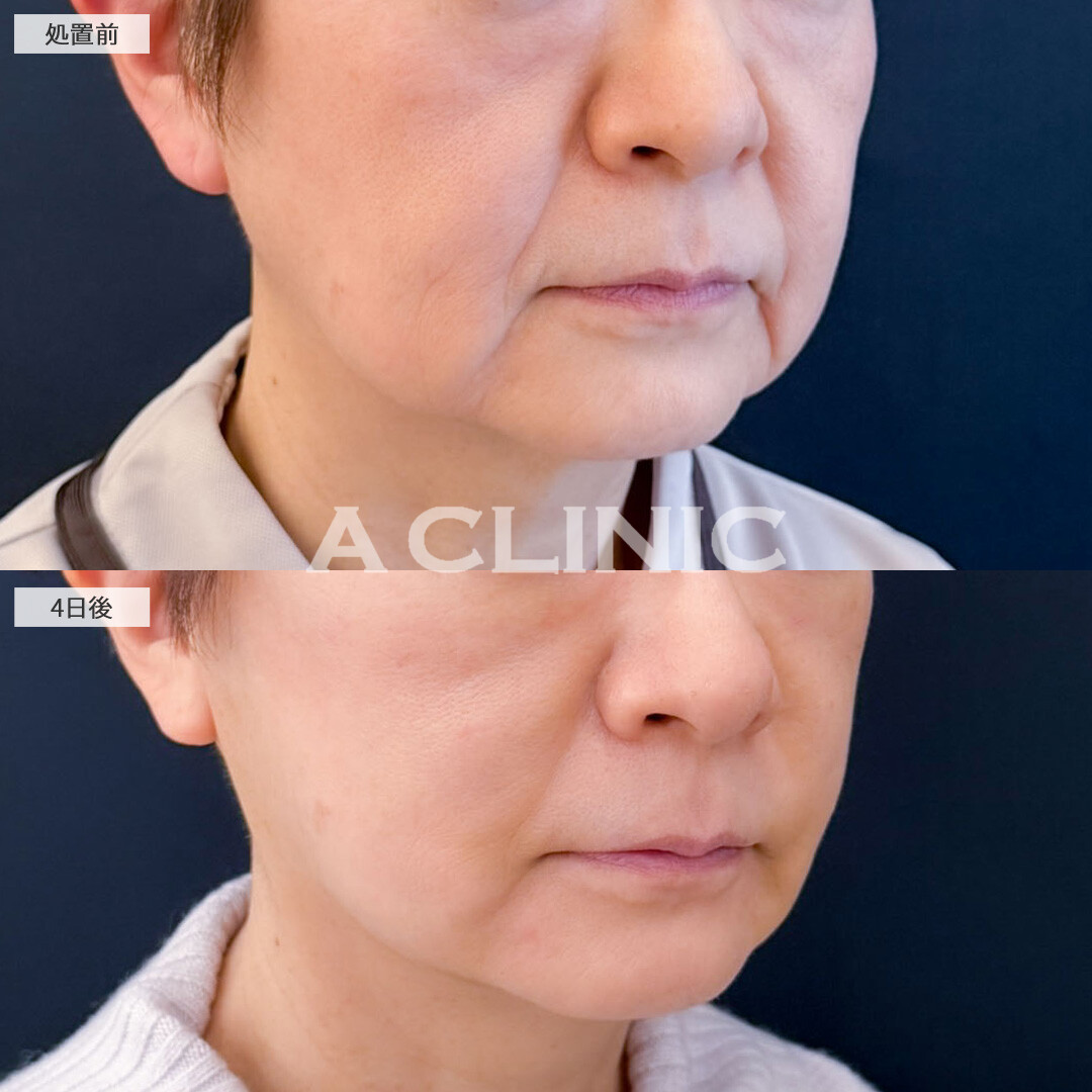 1day小顔脂肪吸引で年齢と共に落ちてきた脂肪を無くしてスッキリ！こちら処置前と4日後の症例です(60代女性)