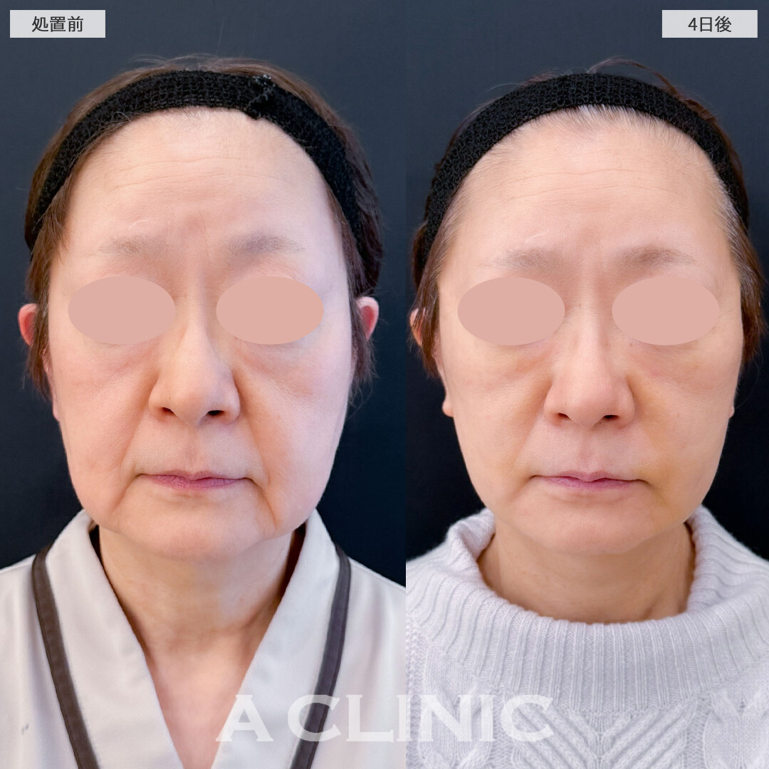 1day小顔脂肪吸引で年齢と共に落ちてきた脂肪を無くしてスッキリ！こちら処置前と4日後の症例です(60代女性)